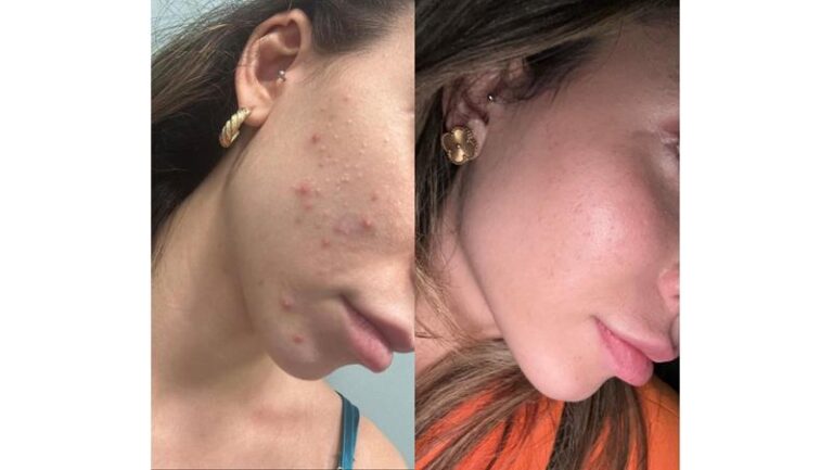 Dra. Dayoha Apresenta o Fotona Booster: Tecnologia e Eficácia no Rejuvenescimento Facial