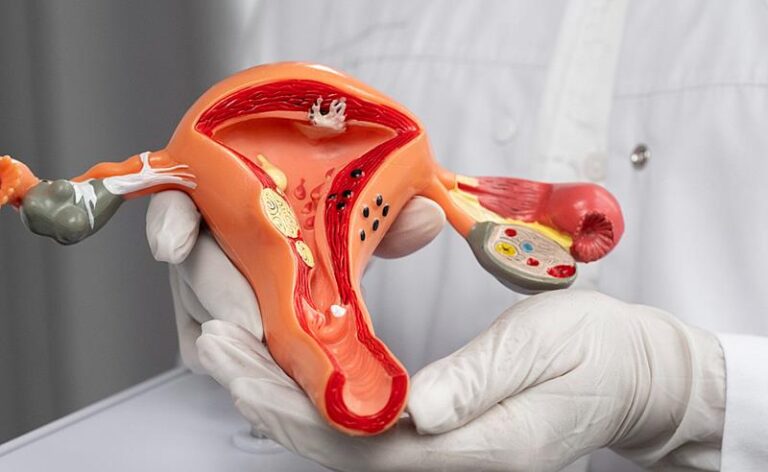 Mitos e verdades: endometriose ocorre em cada dez mulheres no Brasil e requer atenção médica