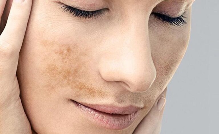 Melasma: por que o tratamento personalizado com ativos manipulados ganha força no outono