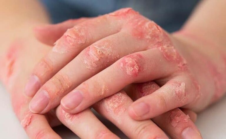 Clínica Pro-Result: Psoríase e Artrite Psoriásica: sintomas, diagnóstico e os tratamentos que mudaram o jogo