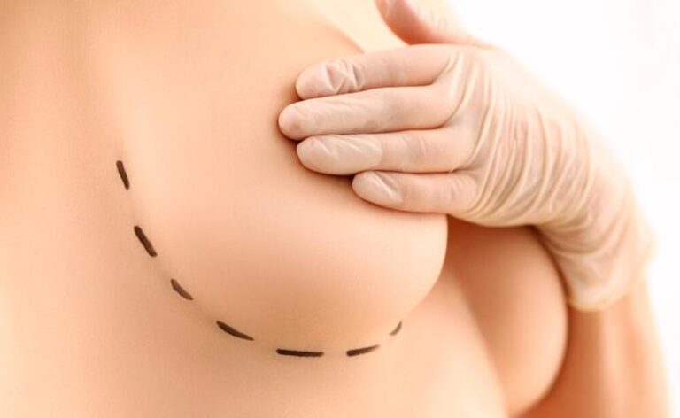 Dr. Octávio Curi Frascareli: Redução de Mamas em Maringá: conforto, saúde e estética