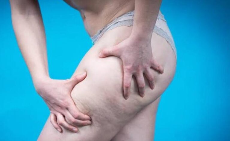 Celulite x Lipedema: entenda as diferenças entre as duas condições que afetam milhões de mulheres