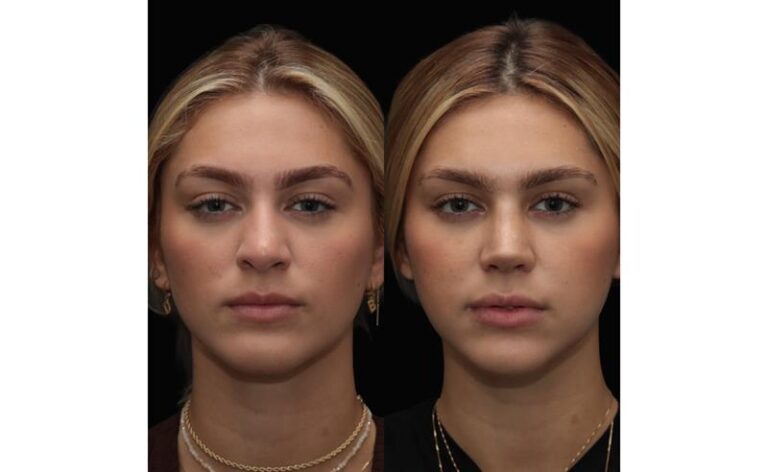 Amiga da cantora Ana Castela realiza sonho da rinoplastia e aposta em técnica que preserva identidade