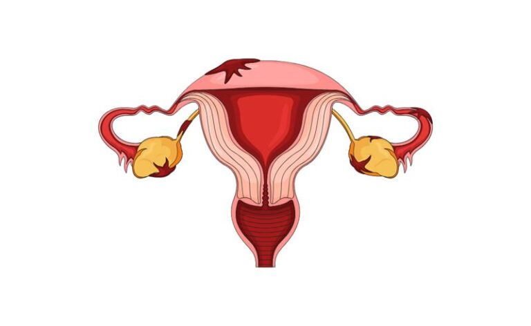 Março Amarelo: Larissa Manoela compartilha diagnóstico de endometriose e reforça importância da informação para mulheres