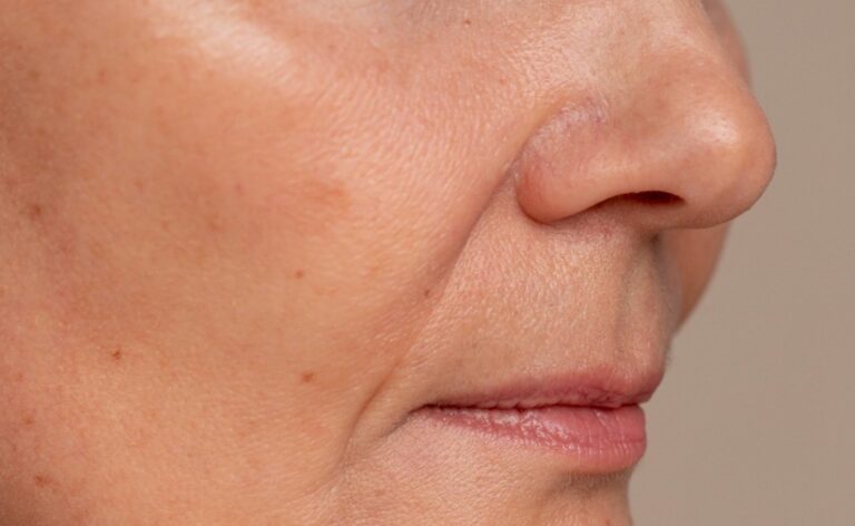 Melasma: a ciência mostra que as manchas podem começar de dentro para fora