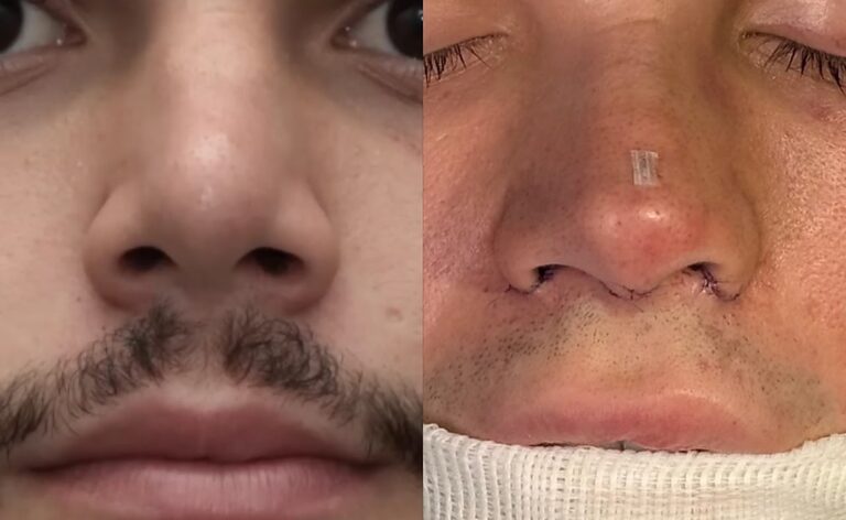 Busca por naturalidade na rinoplastia reflete a tendência do nariz natural entre influenciadores em 2026